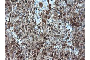 Immunohistochemical staining of paraffin-embedded Carcinoma of Human lung tissue using anti-ADH7 mouse monoclonal antibody. (ADH7 抗体)