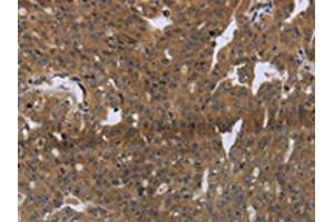 The image on the left is immunohistochemistry of paraffin-embedded Human ovarian cancer tissue using ABIN7191253(LAIR2 Antibody) at dilution 1/20, on the right is treated with synthetic peptide. (LAIR2 抗体)