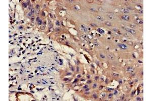 Immunohistochemistry of paraffin-embedded human cervical cancer using ABIN7175830 at dilution of 1:100