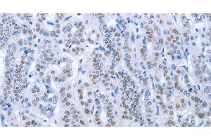 Immunohistochemistry of paraffin-embedded Human thyroid cancer using PAX8 Polyclonal Antibody at dilution of 1:35 (PAX8 抗体)