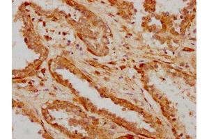 IHC image of ABIN7156114 diluted at 1:600 and staining in paraffin-embedded human prostate cancer performed on a Leica BondTM system. (ILDR1 抗体  (AA 393-541))