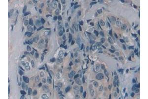 Detection of PRSS1 in Human Breast cancer Tissue using Polyclonal Antibody to Protease, Serine 1 (PRSS1) (PRSS1 抗体  (AA 51-228))
