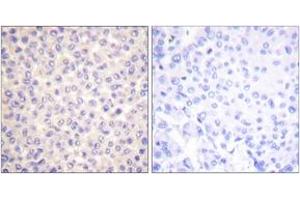 Immunohistochemistry analysis of paraffin-embedded human breast carcinoma, using FADD (Phospho-Ser194) Antibody. (FADD 抗体  (pSer194))