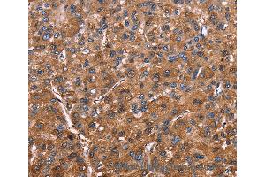 Immunohistochemistry of Human colon cancer using ELP2 Polyclonal Antibody at dilution of 1:40 (ELP2 抗体)