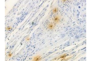 ABIN6257001 and ABIN6274697 at 1/100 staining human tongue carcinoma by IHC-P. (PHLDA1 抗体  (N-Term))