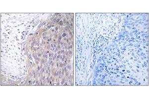 Immunohistochemistry analysis of paraffin-embedded human cervix carcinoma tissue, using POLG2 Antibody. (POLG2 抗体  (AA 291-340))