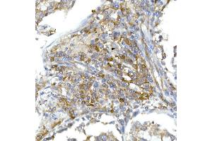 Immunohistochemistry of paraffin-embedded human lung cancer using RPL13 Rabbit mAb (ABIN7269993) at dilution of 1:50 (40x lens). (RPL13 抗体)