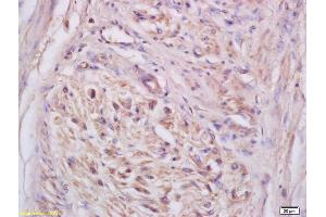 Formalin-fixed and paraffin embedded human cervical carcinoma labeled with Anti-NKG2C Polyclonal Antibody, Unconjugated (ABIN739950) at 1:200 followed by conjugation to the secondary antibody and DAB staining (KLRC2 抗体)