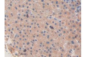 Detection of F8 in Human Liver cancer Tissue using Polyclonal Antibody to Coagulation Factor VIII (F8) (Factor VIII 抗体  (AA 2253-2346))