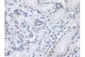 IHC-P analysis of Human Stomach Cancer Tissue, with DAB staining. (VCP 抗体  (AA 125-371))