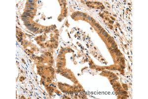 Immunohistochemistry of Human colon cancer using HTR3A Polyclonal Antibody at dilution of 1:50 (Serotonin Receptor 3A 抗体)