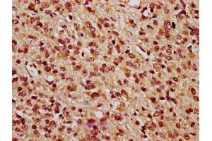 IHC image of ABIN7163751 diluted at 1:100 and staining in paraffin-embedded human glioma performed on a Leica BondTM system. (PARP3 抗体  (AA 1-240))