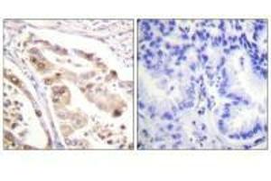 Immunohistochemistry analysis of paraffin-embedded human lung carcinoma tissue using RFA2 (Ab-21) antiobdy. (RPA2 抗体  (Thr21))
