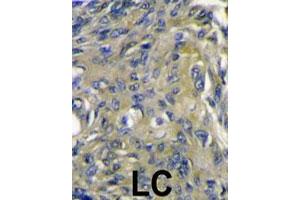 Formalin-fixed and paraffin-embedded human lung carcinoma reacted with FIGF polyclonal antibody  , which was peroxidase-conjugated to the secondary antibody, followed by DAB staining. (VEGFD 抗体  (C-Term))