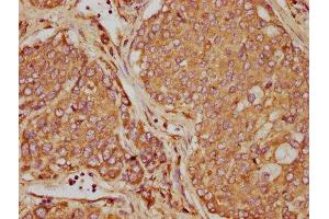 IHC image of ABIN7162214 diluted at 1:90 and staining in paraffin-embedded human liver cancer performed on a Leica BondTM system. (Oncostatin M 抗体  (AA 26-220))
