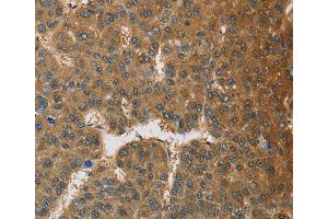 Immunohistochemistry of Human thyroid cancer using TNFRSF10D Polyclonal Antibody at dilution of 1:60 (DcR2 抗体)