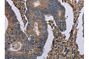 The image on the left is immunohistochemistry of paraffin-embedded Human colon cancer tissue using ABIN7130197(MCM3AP Antibody) at dilution 1/30, on the right is treated with fusion protein. (GANP 抗体)