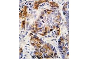 Formalin-fixed and paraffin-embedded human hepatocarcinoma tissue reacted with ALDH4A1 antibody (Center), which was peroxidase-conjugated to the secondary antibody, followed by DAB staining. (ALDH4A1 抗体  (AA 288-314))
