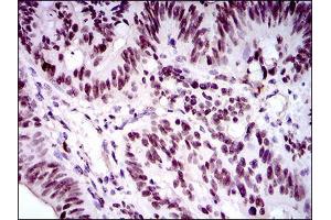 Immunohistochemical analysis of paraffin-embedded rectum cancer tissues using FOXP1 mouse mAb with DAB staining. (FOXP1 抗体  (AA 481-677))