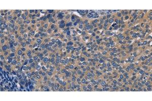 Immunohistochemistry of paraffin-embedded Human cervical cancer using SYT17 Polyclonal Antibody at dilution of 1:60 (SYT17 抗体)