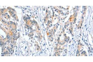 Immunohistochemistry of paraffin-embedded Human colon cancer using Placental Alkaline Phosphatase Polyclonal Antibody at dilution of 1:50 (PLAP 抗体)