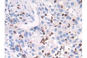 Detection of CTSG in Human Lung cancer Tissue using Polyclonal Antibody to Cathepsin G (CTSG) (Cathepsin G 抗体  (AA 21-255))