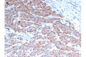 Formalin-fixed, paraffin-embedded human Colon Carcinoma stained with Cytokeratin 18 Mouse Monoclonal Antibody (rKRT18/1190). (Recombinant Cytokeratin 18 抗体)