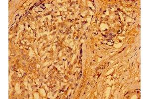 Immunohistochemistry of paraffin-embedded human breast cancer using ABIN7165690 at dilution of 1:100 (PACSIN3 抗体  (AA 1-300))