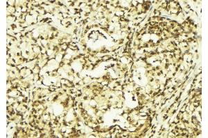 ABIN6269042 at 1/100 staining Human breast cancer tissue by IHC-P. (HSPB6 抗体  (N-Term))