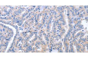 Immunohistochemistry of paraffin-embedded Human thyroid cancer using B3GAT1 Polyclonal Antibody at dilution of 1:40 (CD57 抗体)