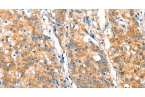 Immunohistochemistry of paraffin-embedded Human gasrtic cancer tissue using ST14 Polyclonal Antibody at dilution 1:70 (ST14 抗体)