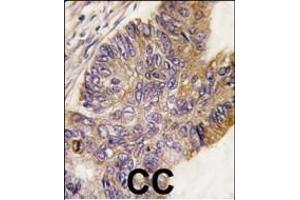 Formalin-fixed and paraffin-embedded human colon carcinoma tissue reacted with RPS6KA1 Antibody , which was peroxidase-conjugated to the secondary antibody, followed by DAB staining. (RPS6KA1 抗体  (AA 710-735))