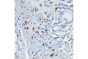 Immunohistochemistry of paraffin-embedded Human pancreatic panniculitis using GSDME Rabbit pAb (ABIN6127757, ABIN6139554, ABIN6139555 and ABIN6223304) at dilution of 1:50 (40x lens). (Non-Syndromic Hearing Impairment Protein 5 (GSDME) (AA 1-260) 抗体)