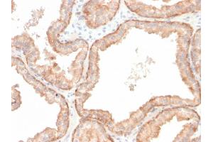 Formalin-fixed, paraffin-embedded human prostate carcinoma stained with Interleukin 10 Recombinant Rabbit Monoclonal Antibody (IL10/2651R). (Recombinant IL-10 抗体)