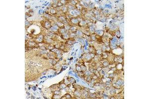Immunohistochemistry of paraffin-embedded human lung cancer using CYLD Rabbit pAb (ABIN1679467, ABIN3018138, ABIN3018139 and ABIN6220378) at dilution of 1:100 (40x lens).