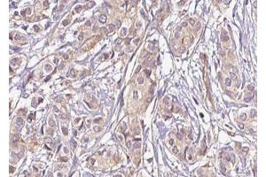ABIN6269375 at 1/100 staining Human breast cancer tissue by IHC-P. (DPYSL2 抗体  (C-Term))