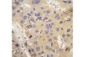 Immunohistochemical staining of formalin-fixed and paraffin-embedded human hepatocarcinoma tissue reacted with ATG12 monoclonal antibody  at 1:50-1:200 dilution. (ATG12 抗体)