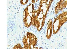 IHC testing of human prostate carcinoma with PSAP antibody (clone PSPN1-1). (Prosaposin 抗体)