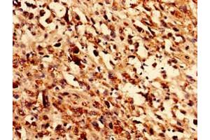 Immunocytochemistry analysis of human melanoma using ABIN7162002 at dilution of 1:100 (GLE1 抗体  (AA 141-380))
