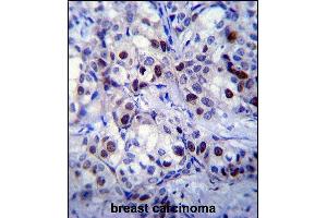 RB1 Antibody  (ABIN1881730 and ABIN2840685) immunohistochemistry analysis in formalin fixed and paraffin embedded human breast carcinoma followed by peroxidase conjugation of the secondary antibody and DAB staining. (Retinoblastoma 1 抗体  (AA 586-615))