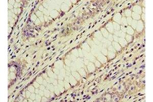 Immunohistochemistry of paraffin-embedded human colon cancer using ABIN7143179 at dilution of 1:100