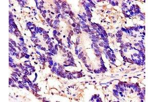 Immunohistochemistry of paraffin-embedded human colon cancer using ABIN7172305 at dilution of 1:100 (TOR1A 抗体  (AA 88-125))