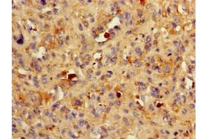 Immunohistochemistry of paraffin-embedded human melanoma using ABIN7145531 at dilution of 1:100 (BACE1 抗体  (AA 46-155))