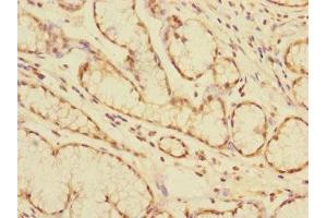 Immunohistochemistry of paraffin-embedded human colon cancer using ABIN7146795 at dilution of 1:100 (CEACAM4 抗体  (AA 36-155))