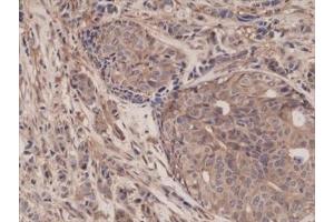 IHC testing of FFPE human breast cancer tissue with recombinant p65 antibody at 1:1250.
