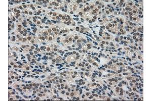 Immunohistochemical staining of paraffin-embedded Adenocarcinoma of breast tissue using anti-LDHA mouse monoclonal antibody. (Lactate Dehydrogenase A 抗体)