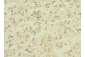 Immunohistochemistry of paraffin-embedded human glioma using ABIN7143380 at dilution of 1:100 (ADGRB1 抗体  (AA 60-350))