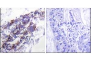 Immunohistochemistry analysis of paraffin-embedded human breast carcinoma tissue, using Keratin 8 Antibody. (KRT8 抗体  (AA 434-483))