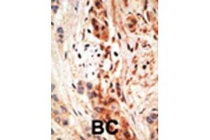 Formalin-fixed and paraffin-embedded human cancer tissue reacted with the APOBEC3A polyclonal antibody  , which was peroxidase-conjugated to the secondary antibody, followed by AEC staining. (APOBEC3A 抗体  (N-Term))
