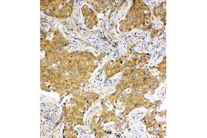 Anti-Hsc70 antibody, IHC(P) IHC(P): Human Lung Cancer Tissue (Hsc70 抗体  (C-Term))